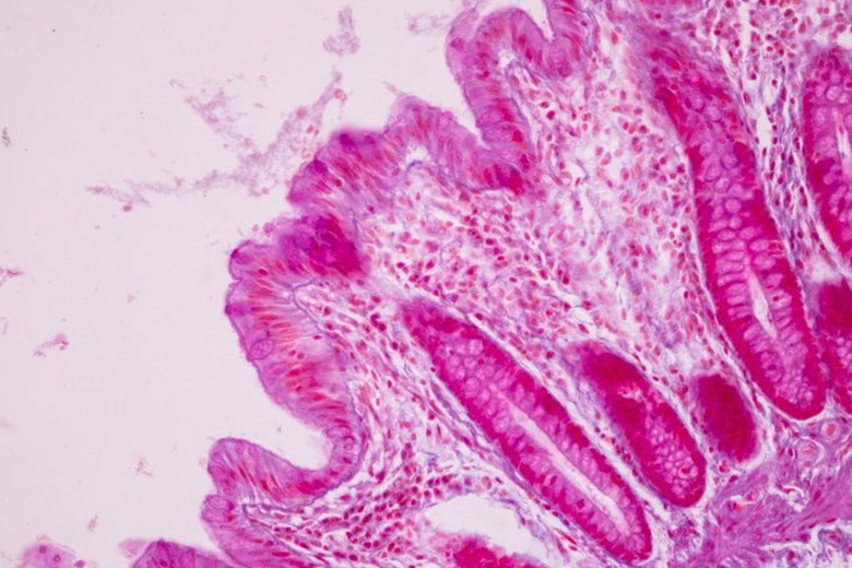 Tumori stromali gastrointestinali: una nuova strada per contrastare la farmaco-resistenza