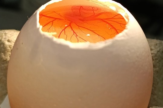 Un “avatar” del tumore per studiare e combattere l’osteosarcoma pediatrico